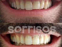 Restauración de bordes incisales mediante carillas directas de composite. 